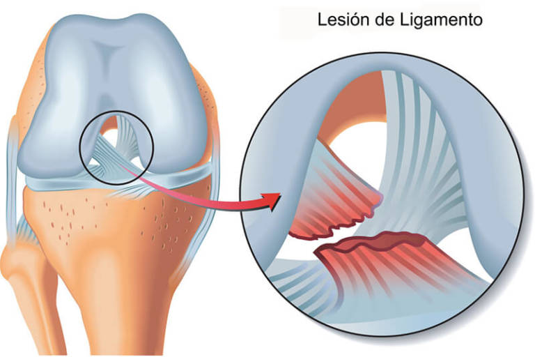 Cuál es la diferencia entre músculos tendones y ligamentos